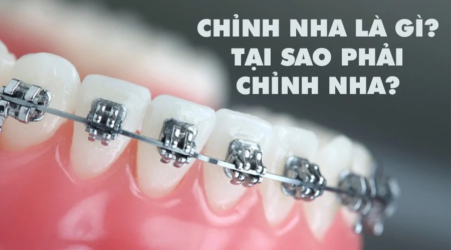 Chỉnh nha là gì Chỉnh nha là gì
