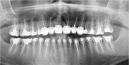 Chụp X-quang bọc răng sứ Chụp X-quang bọc răng sứ