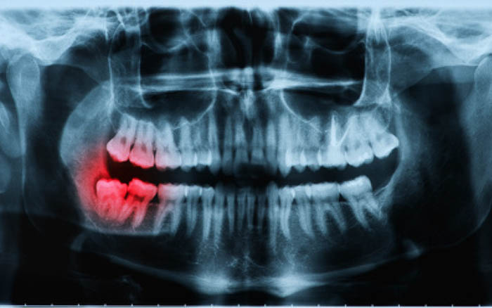 Chụp x-quang răng 8 Chụp x-quang răng 8
