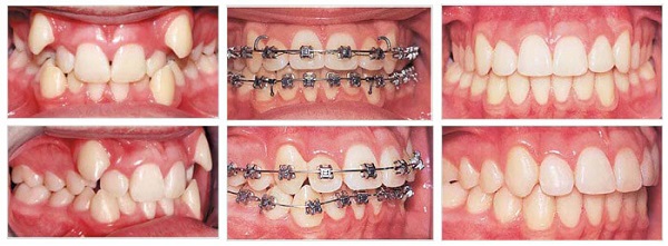 Dàn đều răng Dàn đều răng