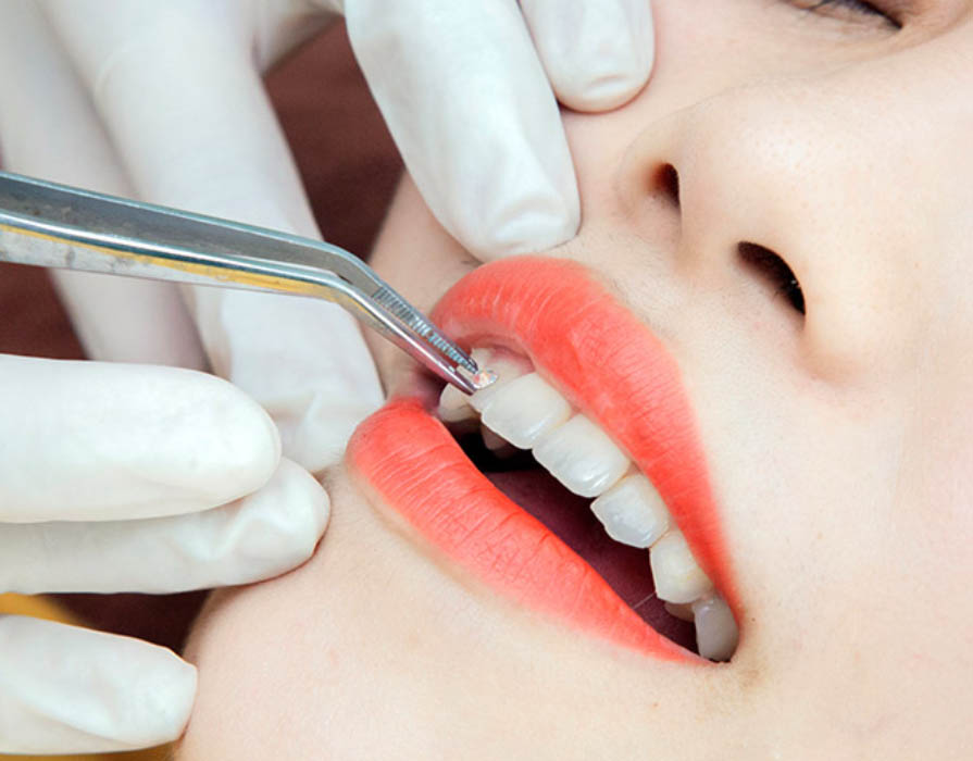 Đính đá vào răng tại Hanseoul Đính đá vào răng tại Hanseoul