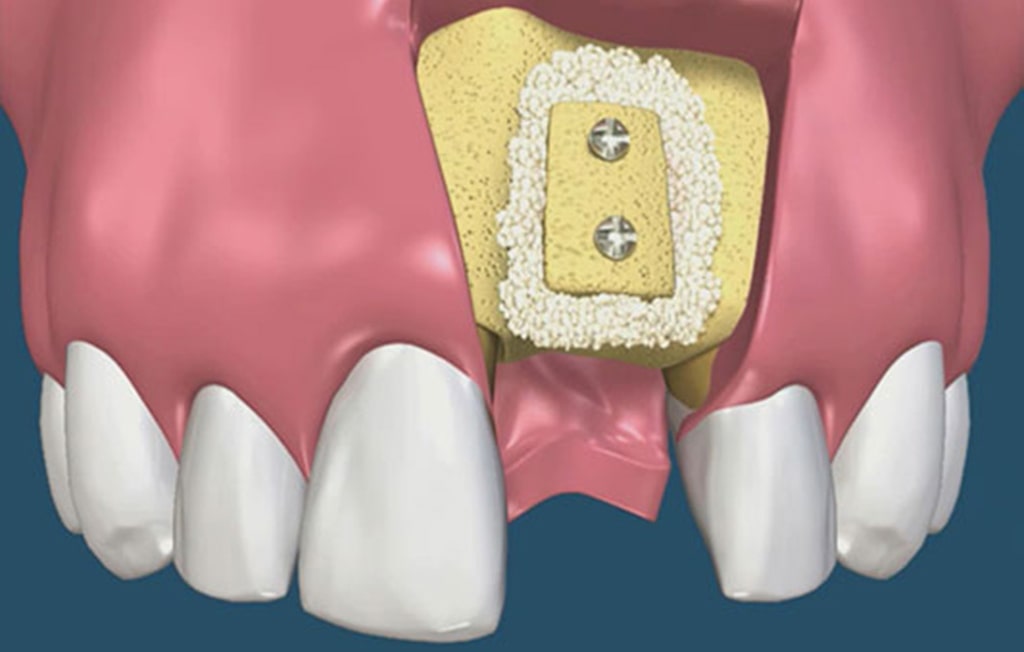Ghép xương răng implant