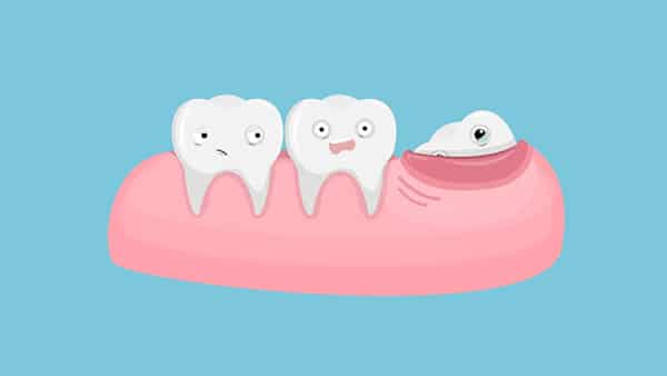 Khái niệm răng khôn Khái niệm răng khôn