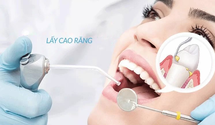 Lợi ích của lấy cao răng định kì Lợi ích của lấy cao răng định kì