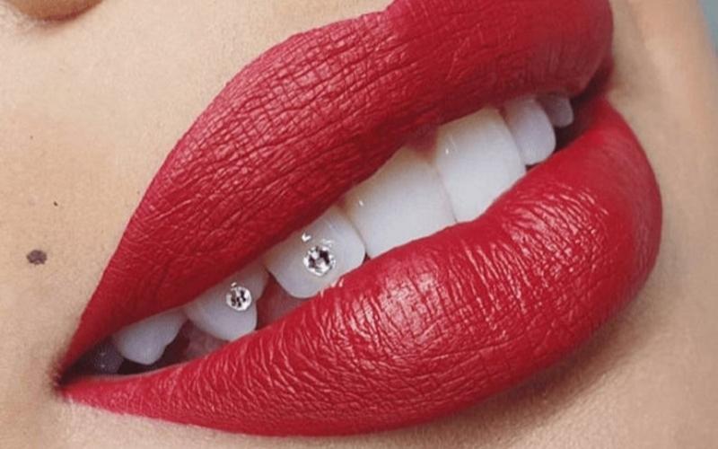 Lý do đính đá răng Lý do đính đá răng