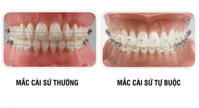 Mắc cài sứ thương và mắc cài sứ tự buộc Mắc cài sứ thương và mắc cài sứ tự buộc