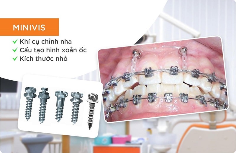 Minivis chỉnh nha Minivis chỉnh nha