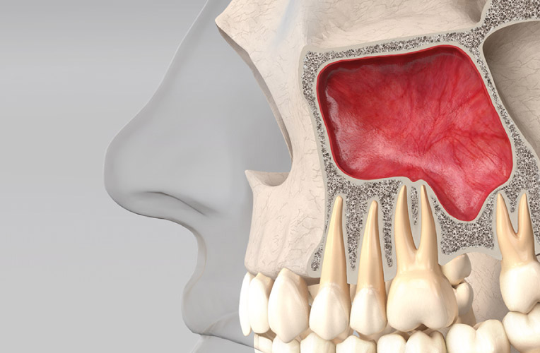 Nâng xoang là gì?