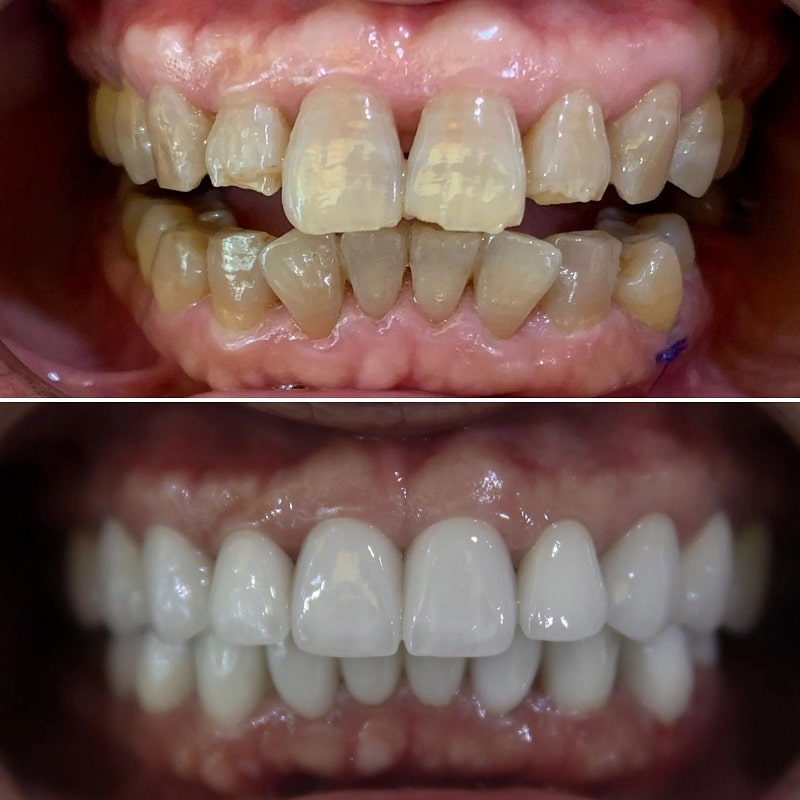 Nên bọc răng sứ Nên bọc răng sứ