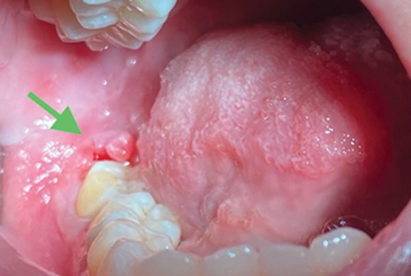 Nhiễm trùng khi nhổ răng 8 những biến chứng sau khi nhổ răng số 8