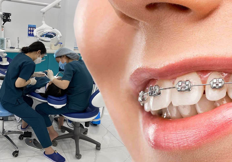 Niềng răng cho bệnh nhân tại Hanseoul Niềng răng cho bệnh nhân tại Hanseoul