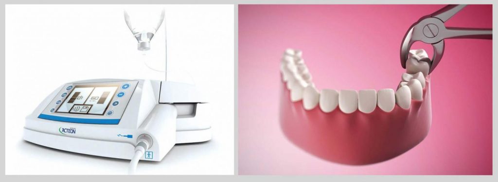 Phương pháp nhổ răng khôn Phương pháp nhổ răng khôn