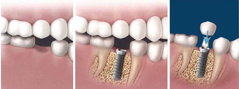 Quy trình trồng răng Implant Quy trình trồng răng Implant