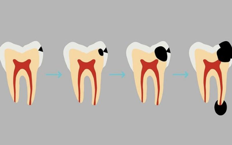 Răng bị chết tủy