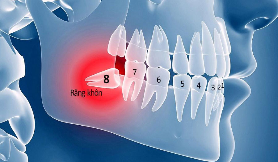 Răng khôn là gì?