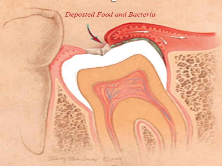 Răng khôn mọc gây viêm lợi Răng khôn mọc gây viêm lợi