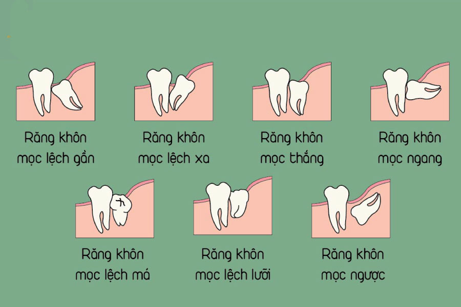 Răng số 8 ảnh hưởng răng 7 Răng số 8 ảnh hưởng răng 7