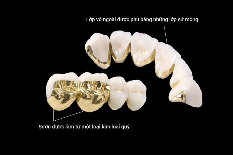 Răng sứ kim loại đẹp