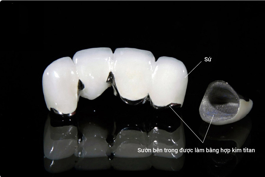 Răng sứ kim loại titan