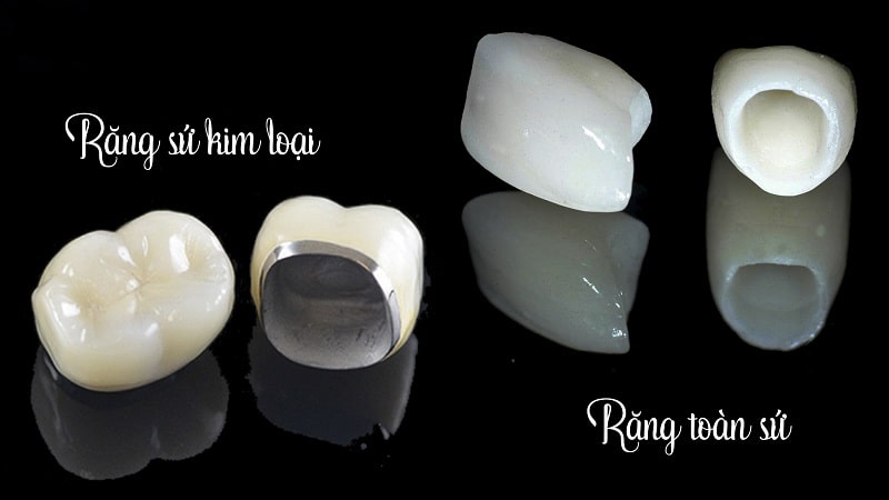 Răng sứ kim loại và răng toàn sứ