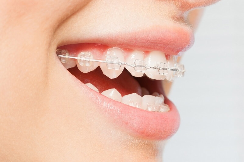 Tẩy trắng khi niềng