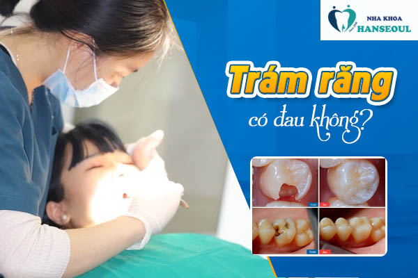 Trám răng có đau không Trám răng có đau không