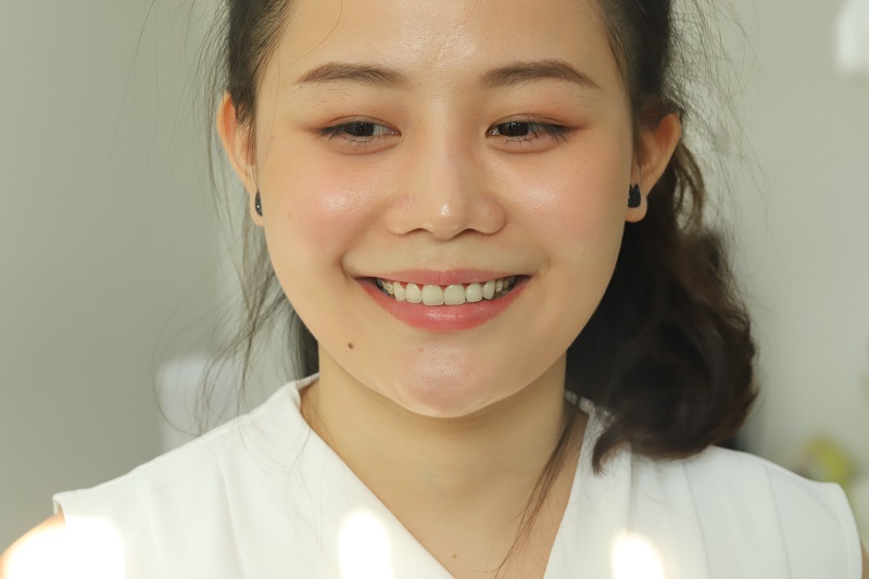 Bệnh nhân trám răng thẩm mỹ tại Hanseoul Bệnh nhân trám răng thẩm mỹ tại Hanseoul