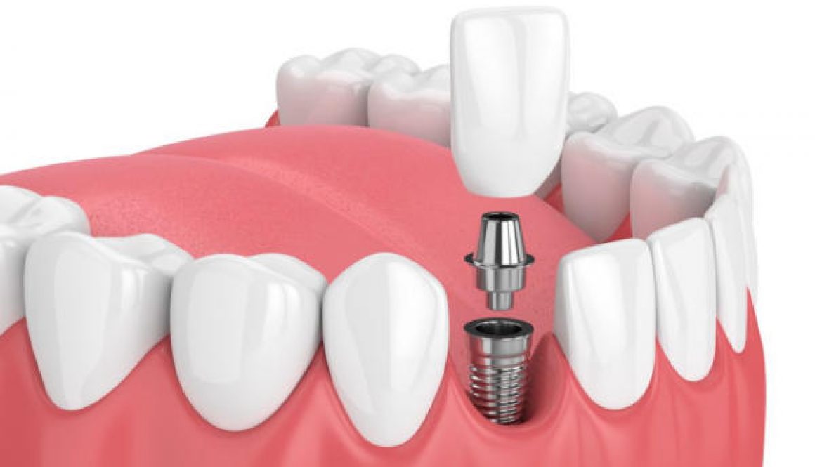Trồng răng implant all on 4 và 6