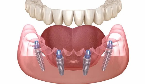 Trồng răng implant all on 4