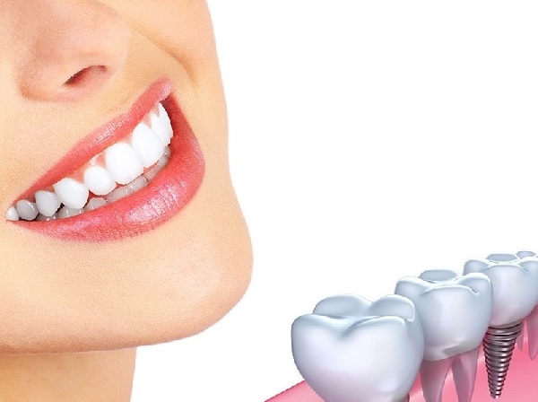 Trồng răng implant có nguy hiểm không Trồng răng implant có nguy hiểm không