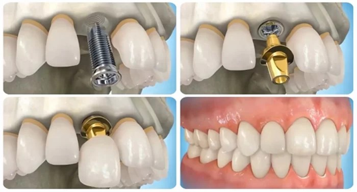trồng răng implant so với các trồng răng giả truyền thống trồng răng implant so với các trồng răng giả truyền thống