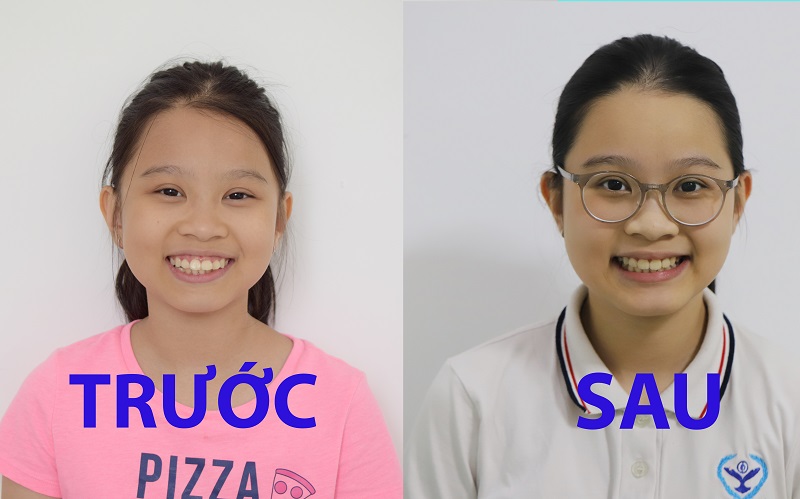 Trước và sau khi niềng răng của bệnh nhân tại nha khoa Hanseoul Trước và sau khi niềng răng của bệnh nhân tại nha khoa Hanseoul