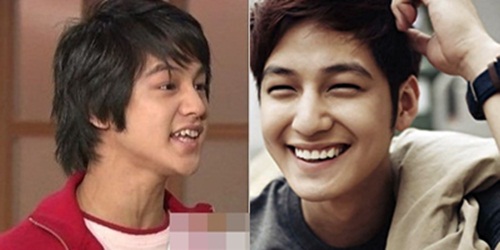 Trước sau khi niềng răng sao Hàn Trước sau khi niềng răng sao Hàn