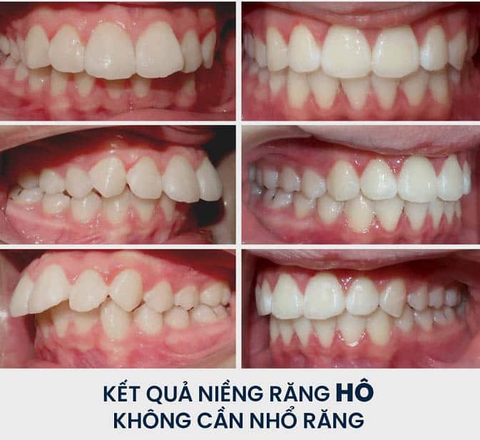 Trước sau niềng răng Trước sau niềng răng