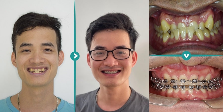 Trước sau khi niềng răng tại nha khoa Hansoeul Trước sau khi niềng răng tại nha khoa Hansoeul