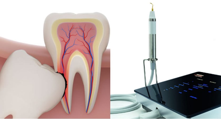 Ưu điểm của nhổ răng khôn bằng máy siêu âm