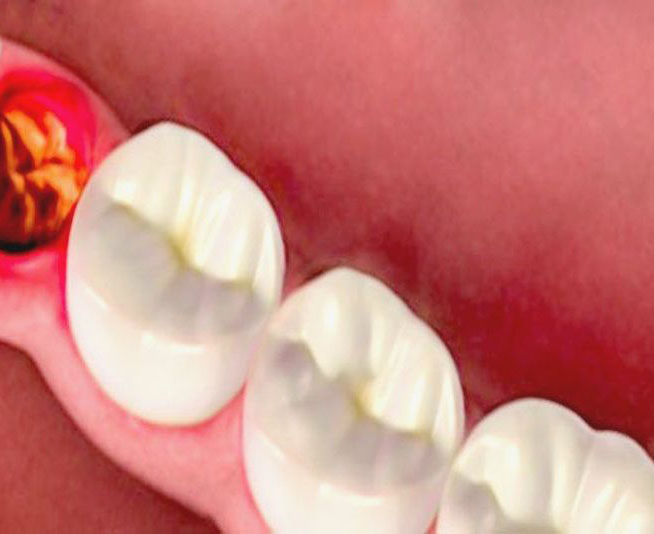 Viêm ổ răng khôn Viêm ổ răng khôn