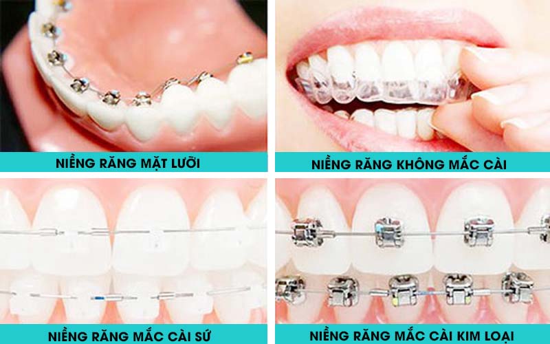 Các loại niềng răng Các loại niềng răng