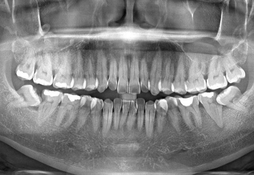 Nhổ răng khôn ca khó Nhổ răng khôn ca khó