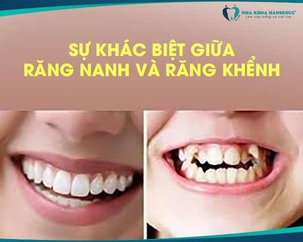 răng nanh và răng khểnh
