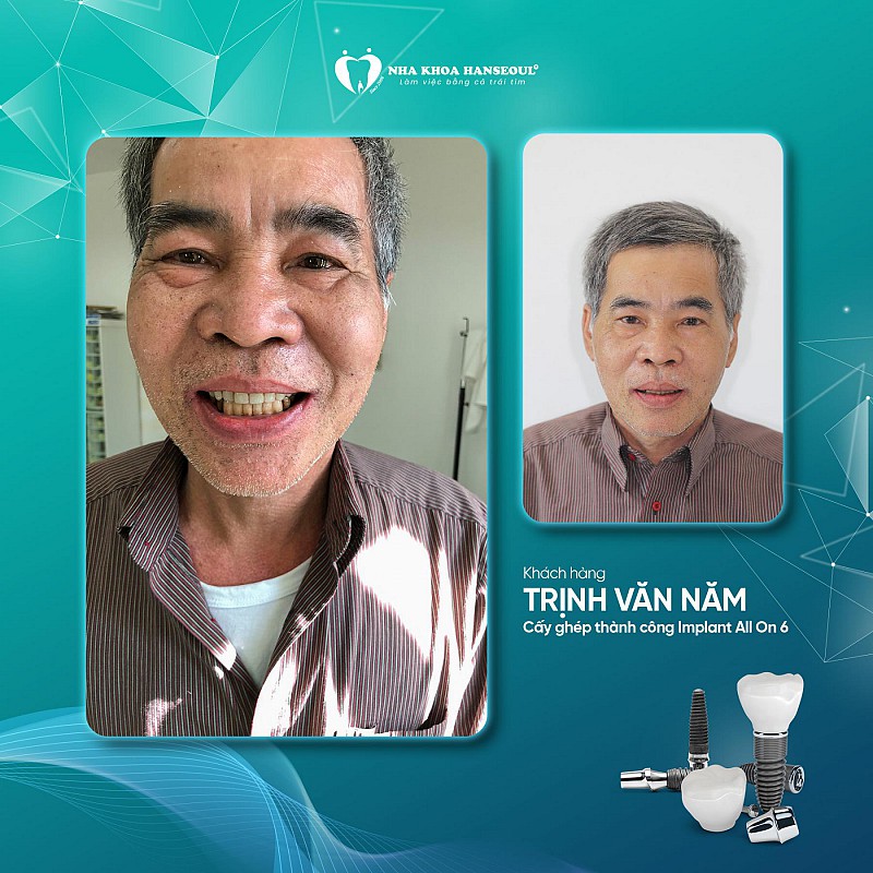 Khách hàng Trịnh Văn Năm cấy ghép implant All on 6 Khách hàng Trịnh Văn Năm cấy ghép implant All on 6